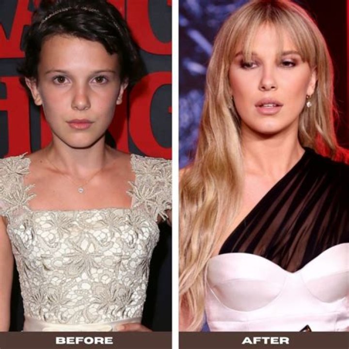 Unveiling The Truth Behind Millie Bobby Brown's Plastic Surgery Journey